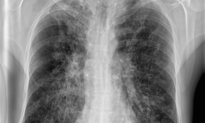 New Cystic Fibrosis Research Examines Deadly Pathogen